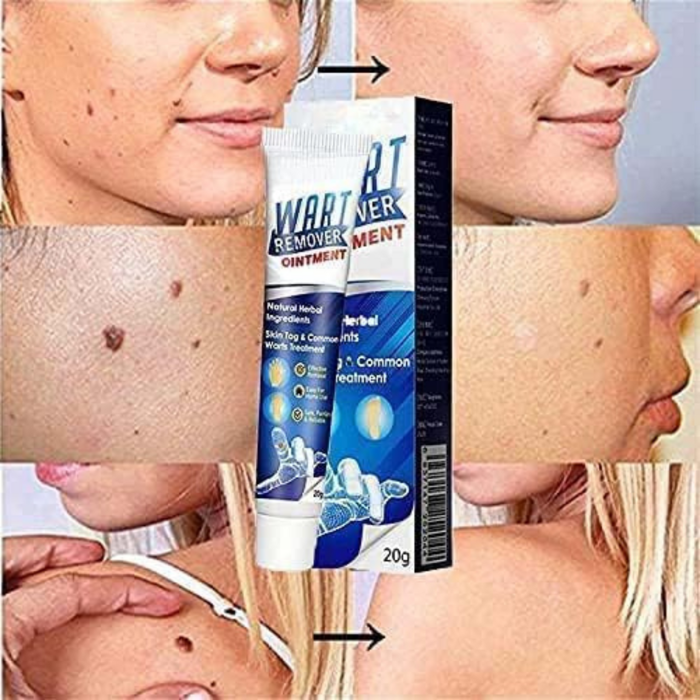 Crema Eliminadora de Verrugas: Solución Rápida y Efectiva